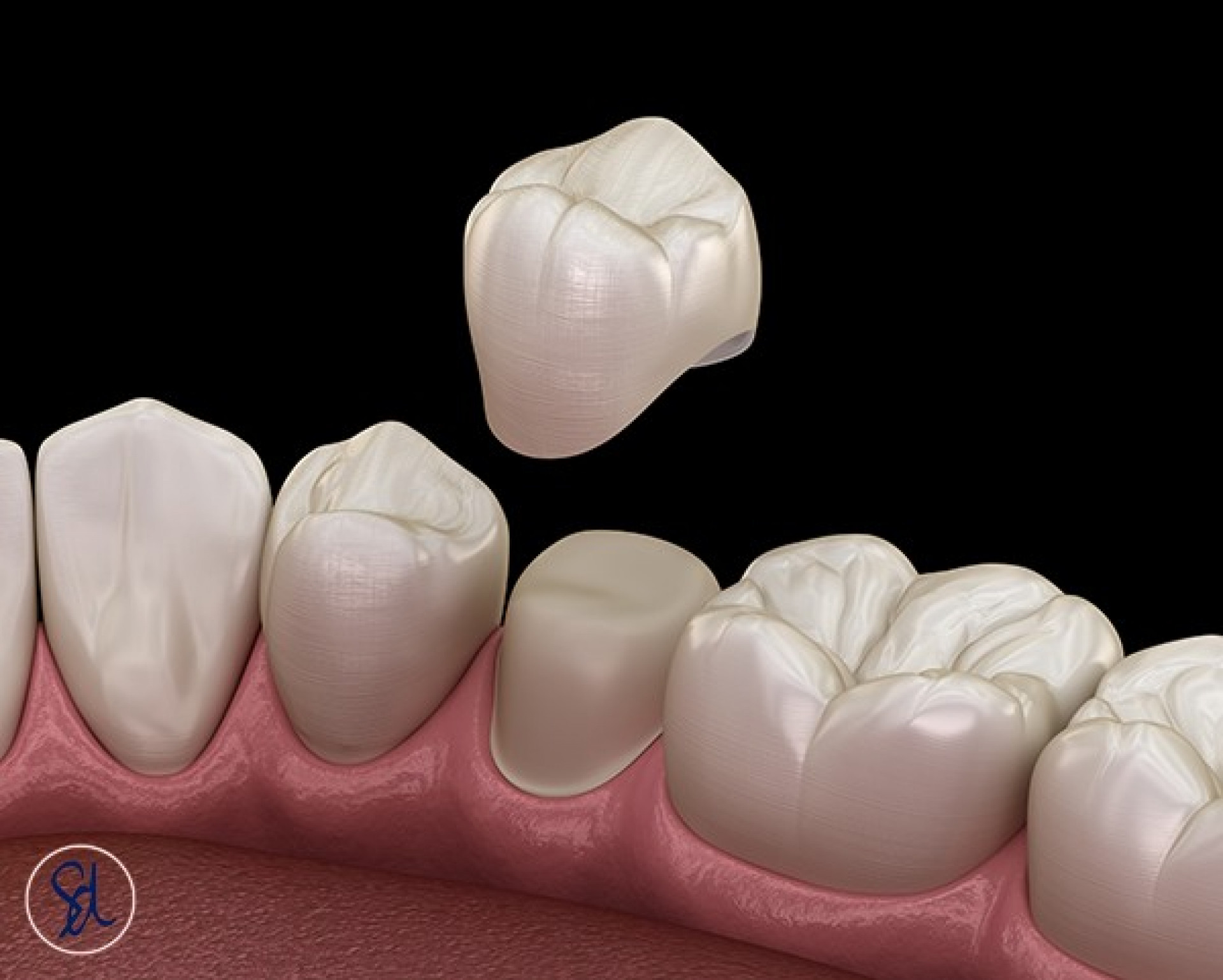 Same Day Dental Crowns Brisbane Information and Costs